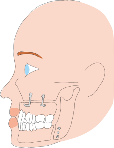 Bi-maxillary osteotomy for sleep apnoea Bi-maxillary osteotomy for sleep apnoea