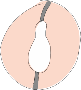 Nasal polyp blocking most of the air passage in the nasal cavity Nasal polyp blocking most of the air passage in the nasal cavity